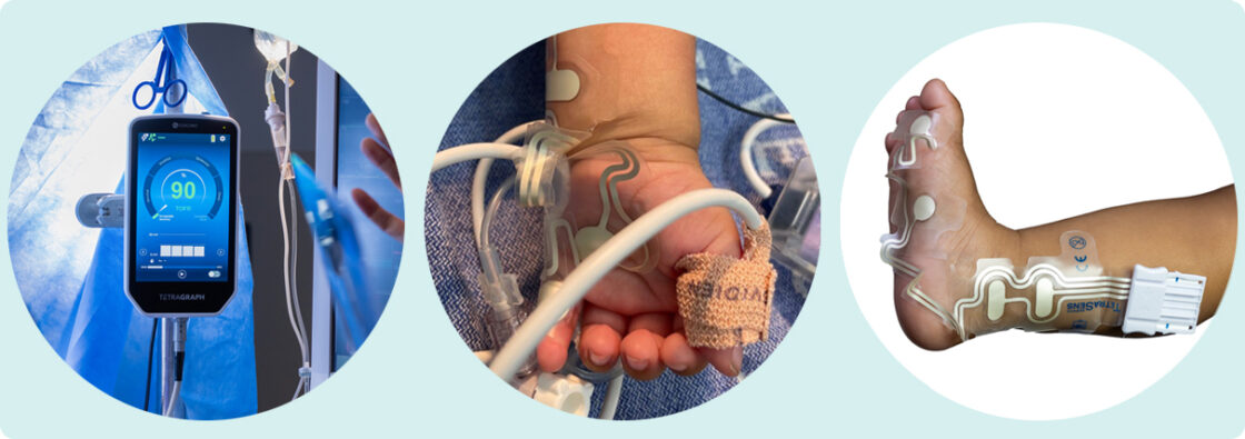 Tre sirkulære bilder viser en medisinsk monitor, en babys hånd med sensorer og en barns fot med elektroder.